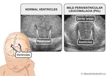 pvl meaning ultrasound